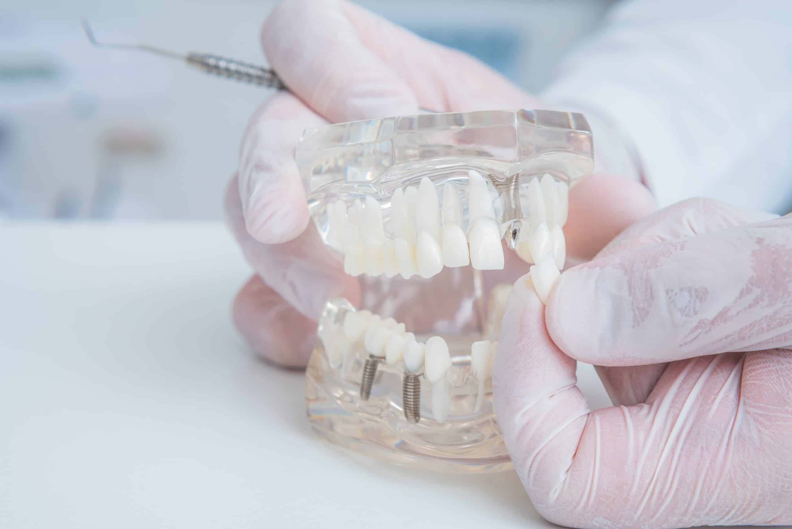 Dental Implants Littleton